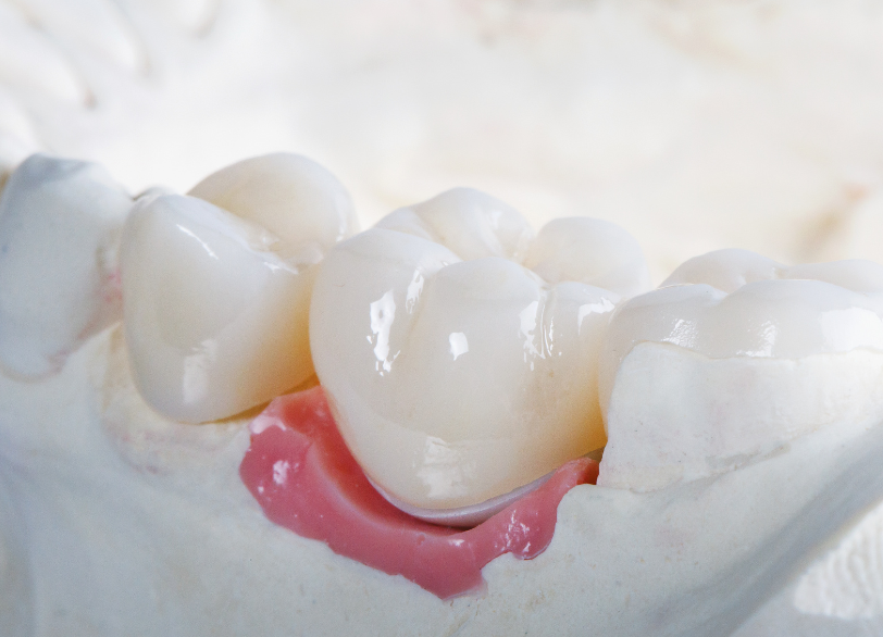 セラミッククラウン｜かながわ歯科