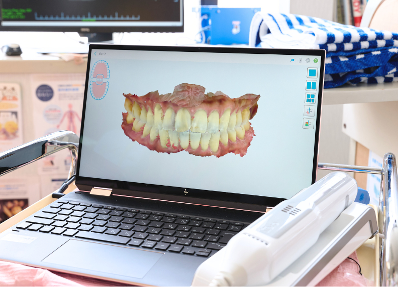 口腔内スキャナー｜大倉歯科