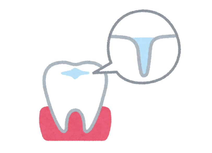 シーラント｜かながわ歯科