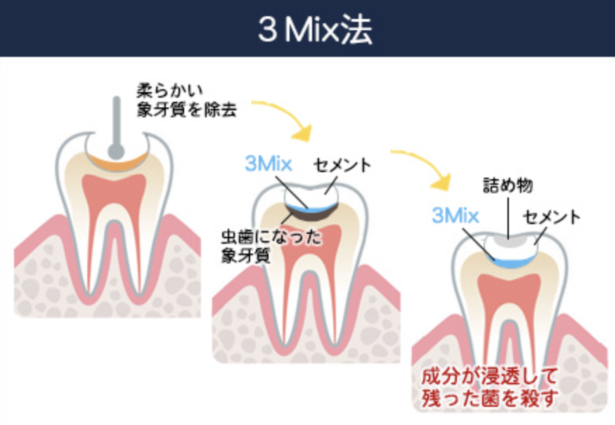 3mix法｜かながわ歯科