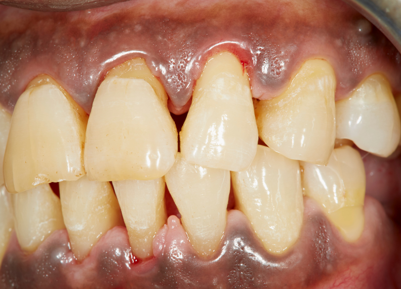 ガムピーリングとは|かながわ歯科