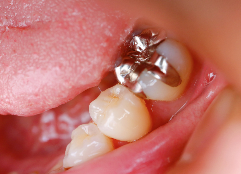 お口の中の「銀歯」が原因|かながわ歯科