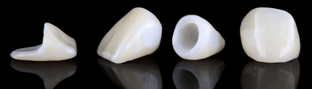 金属を使わない「メタルフリー治療」|かながわ歯科