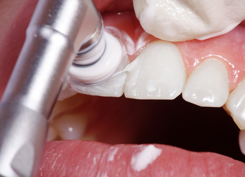 PMTCとは｜かながわ歯科