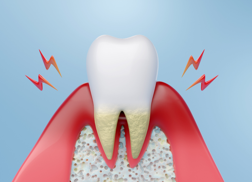 歯茎が失われる理由｜かながわ歯科