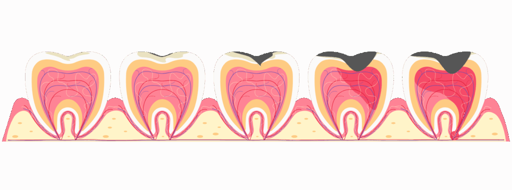 根管治療が必要な症状とは｜かながわ歯科