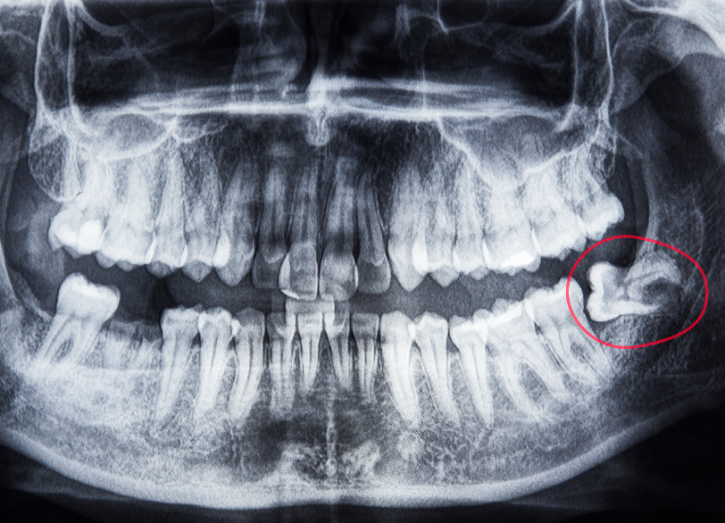 親すらず治療とは｜かながわ歯科